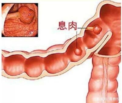 胃腸息肉生長有信號(hào)，該預(yù)防時(shí)要預(yù)防！